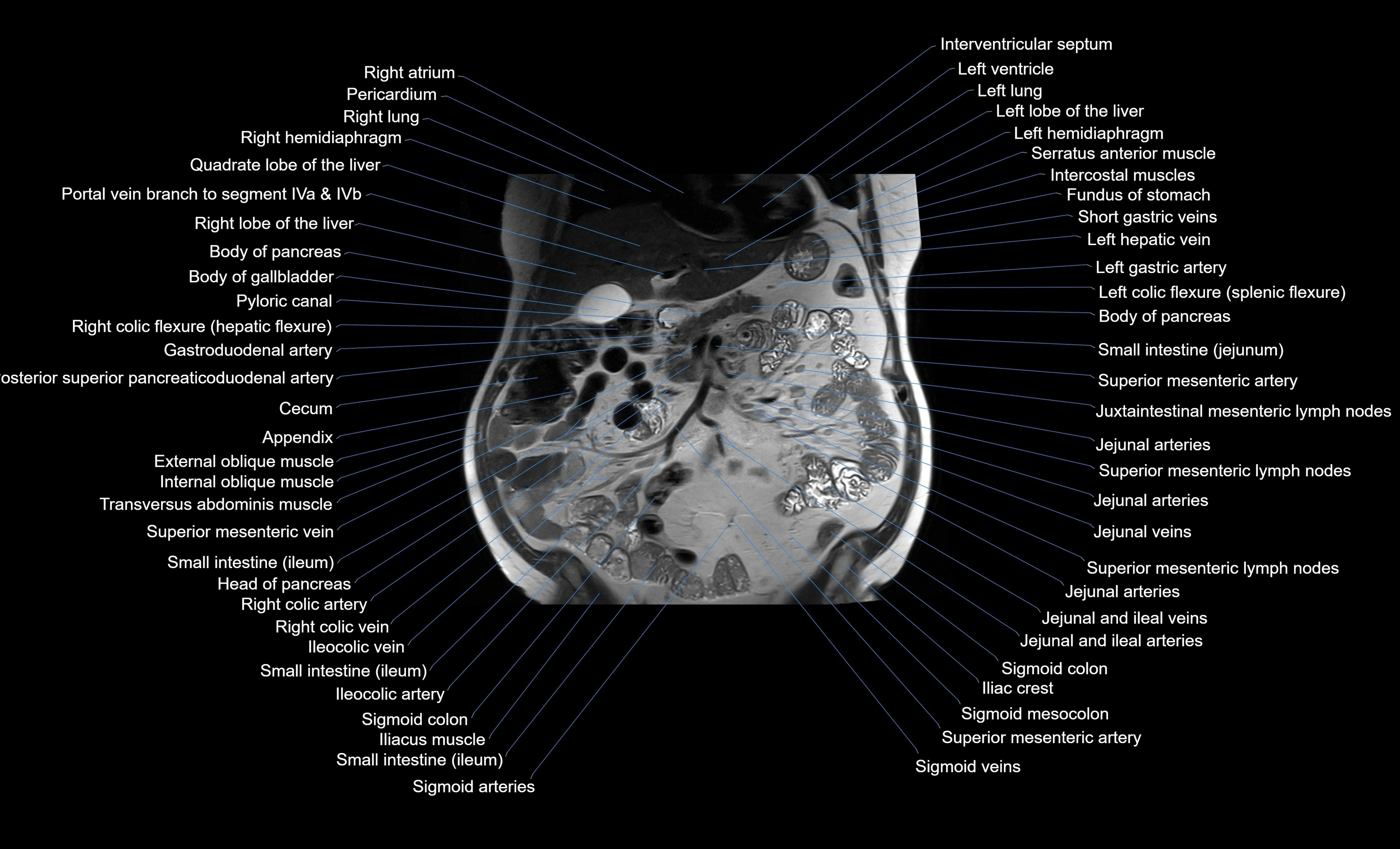MRI Abdomen coronal labelled cross sectional anatomy radiology  image-img-00001-00024.webp